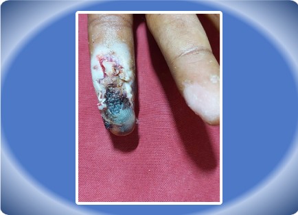 FINGER INJURY